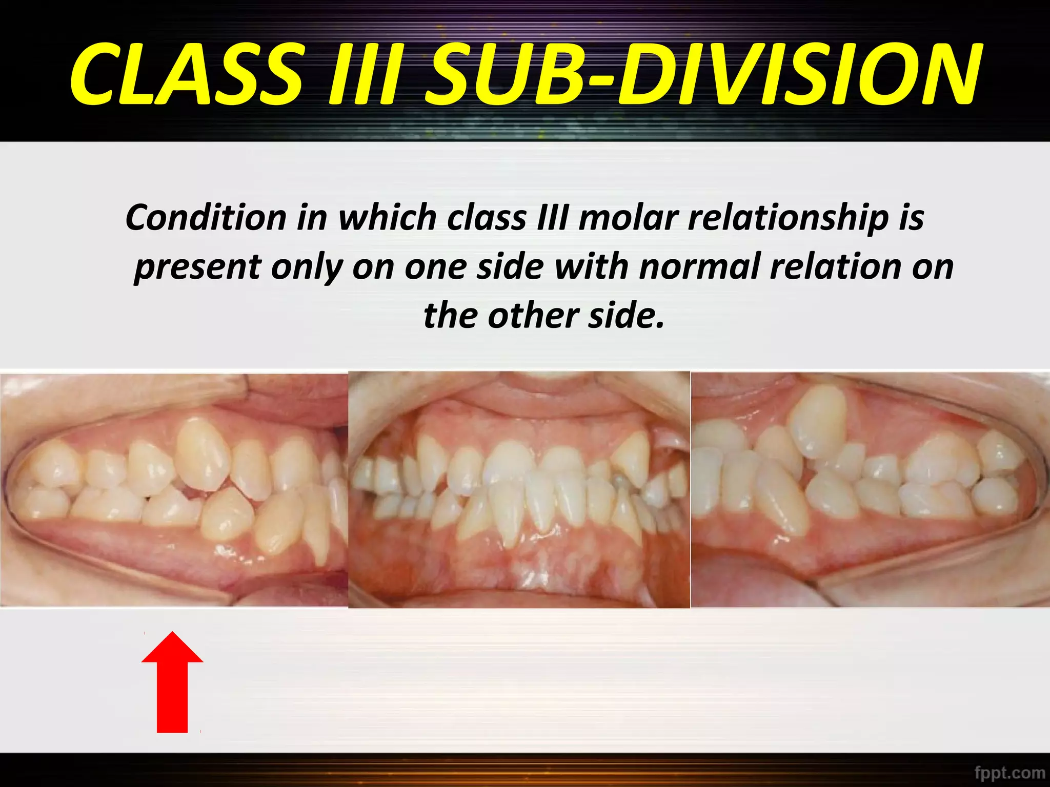 CLASS III SUB-DIVISION
Condition in which class III molar relationship is
present only on one side with normal relation on
the other side.

 