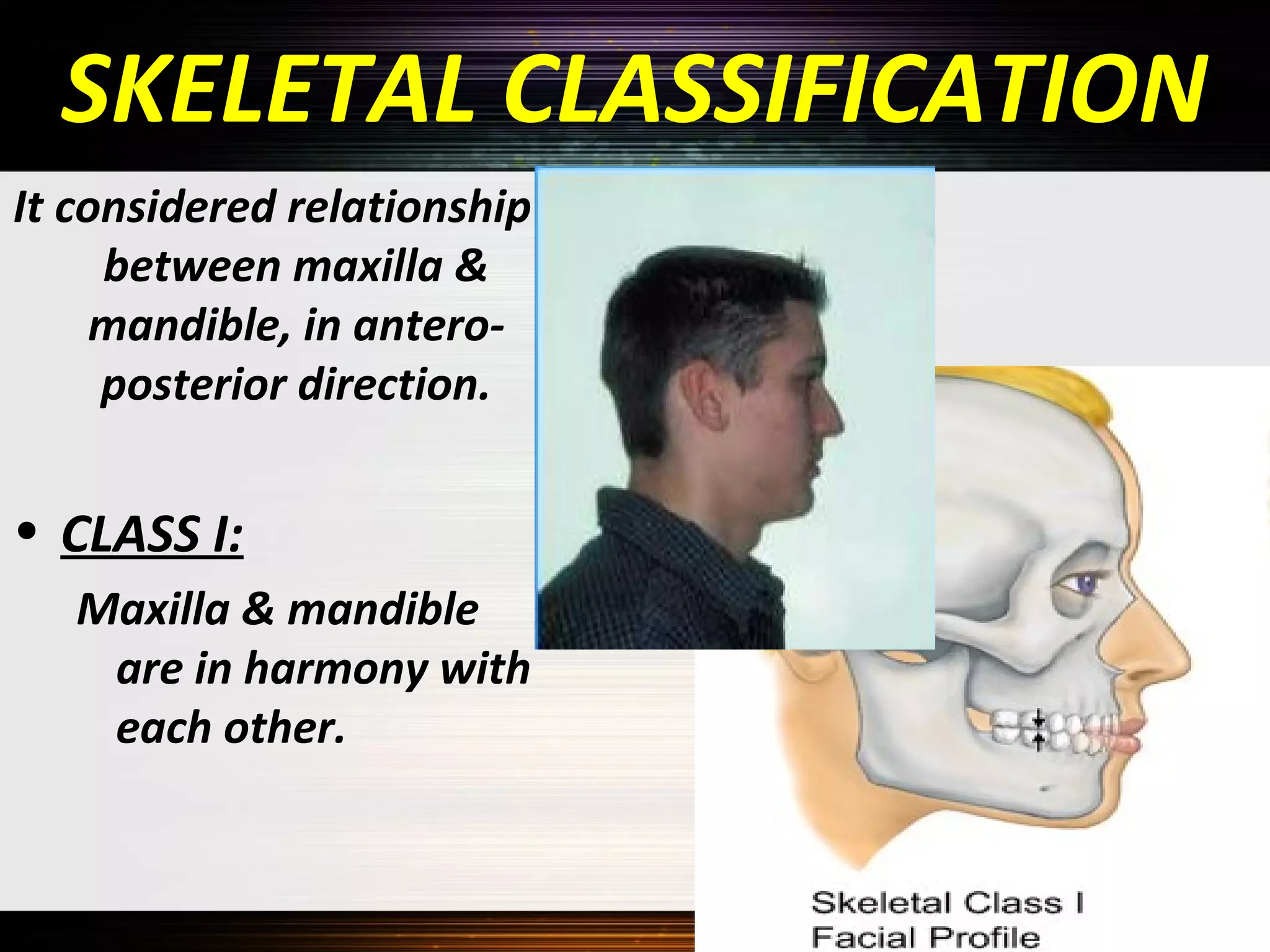 SKELETAL CLASSIFICATION
It considered relationship
between maxilla &
mandible, in anteroposterior direction.

• CLASS I:
Maxilla & mandible
are in harmony with
each other.

 