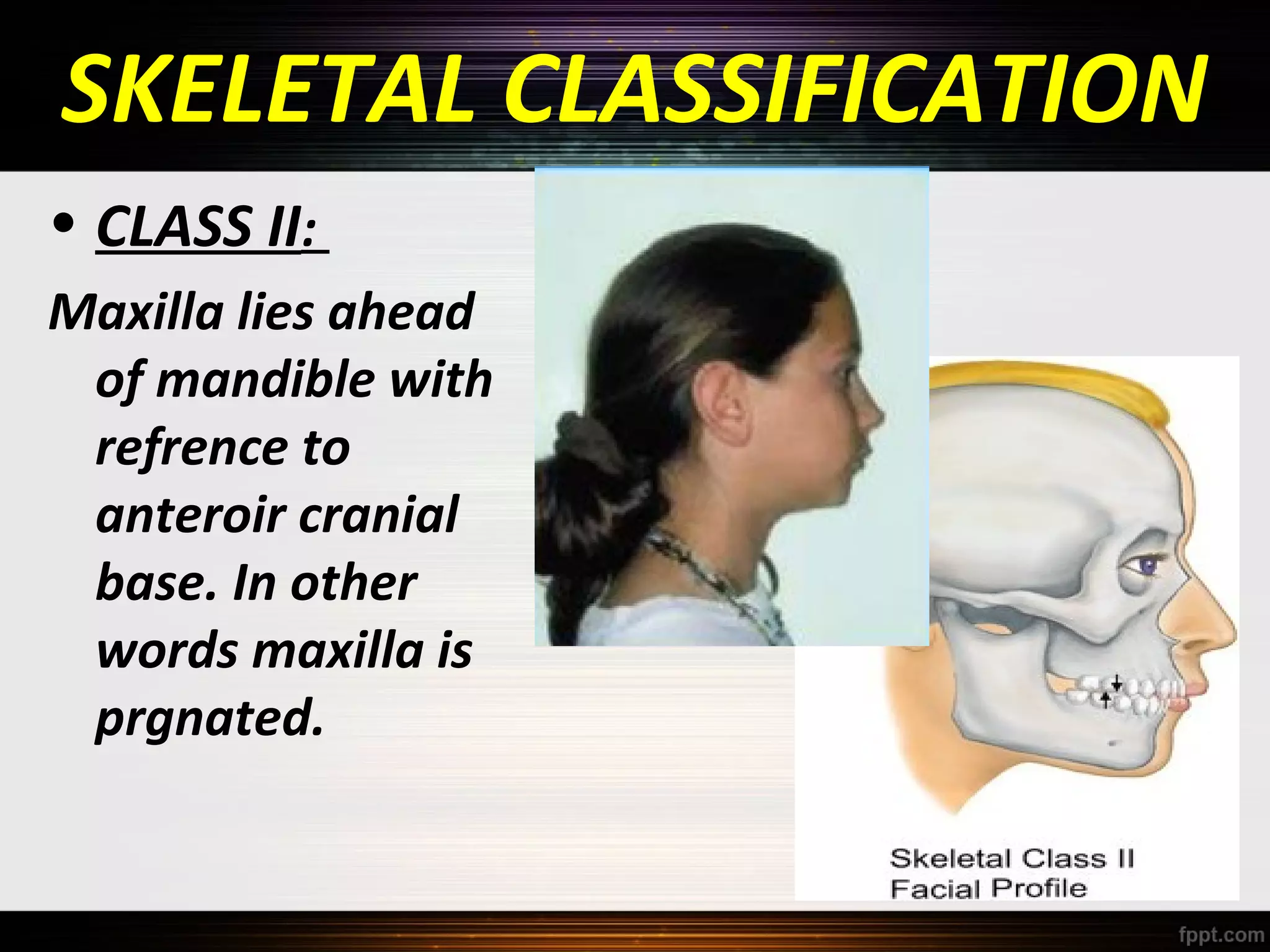 SKELETAL CLASSIFICATION
• CLASS II:
Maxilla lies ahead
of mandible with
refrence to
anteroir cranial
base. In other
words maxilla is
prgnated.

 