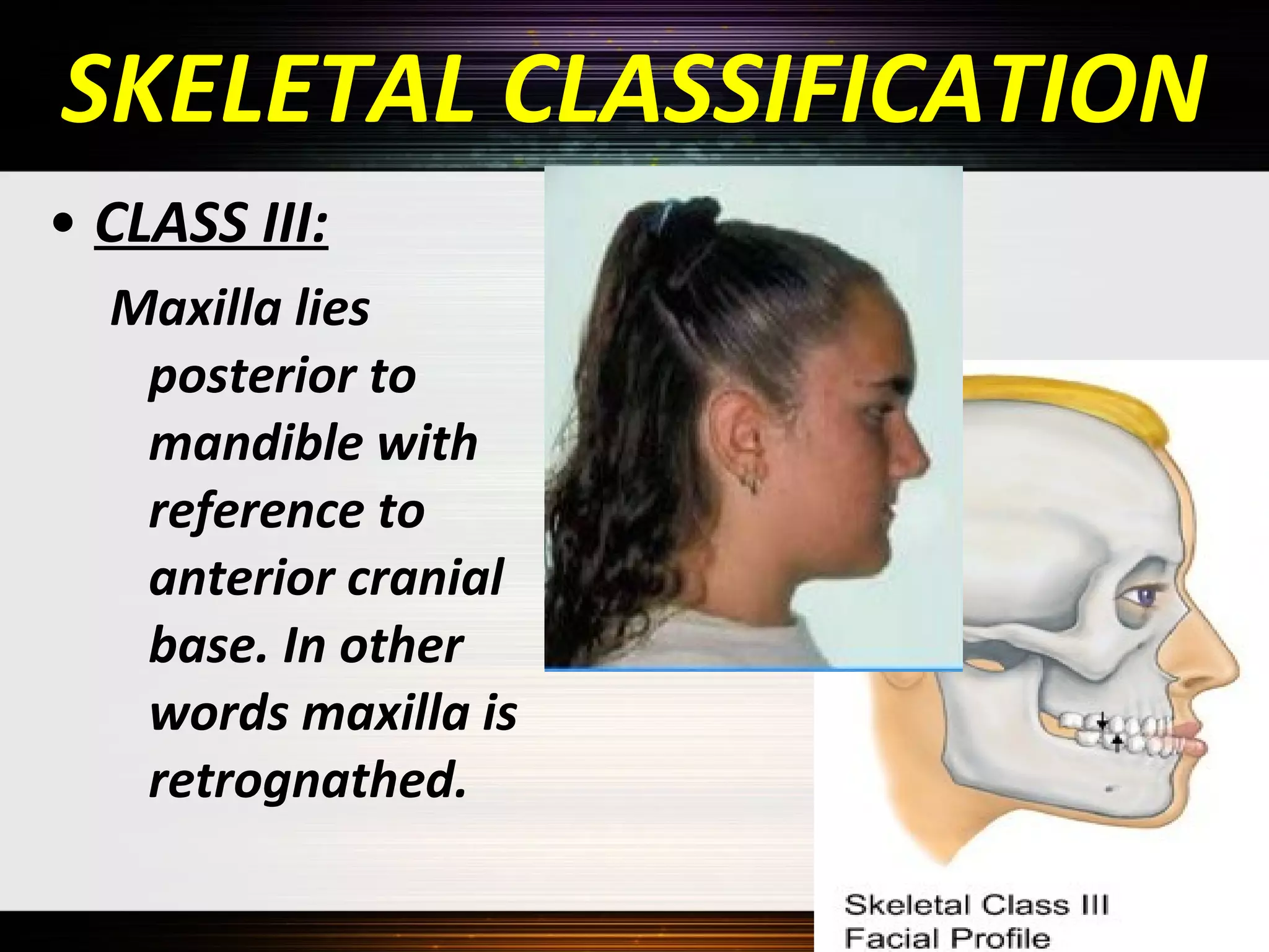 SKELETAL CLASSIFICATION
• CLASS III:
Maxilla lies
posterior to
mandible with
reference to
anterior cranial
base. In other
words maxilla is
retrognathed.

 