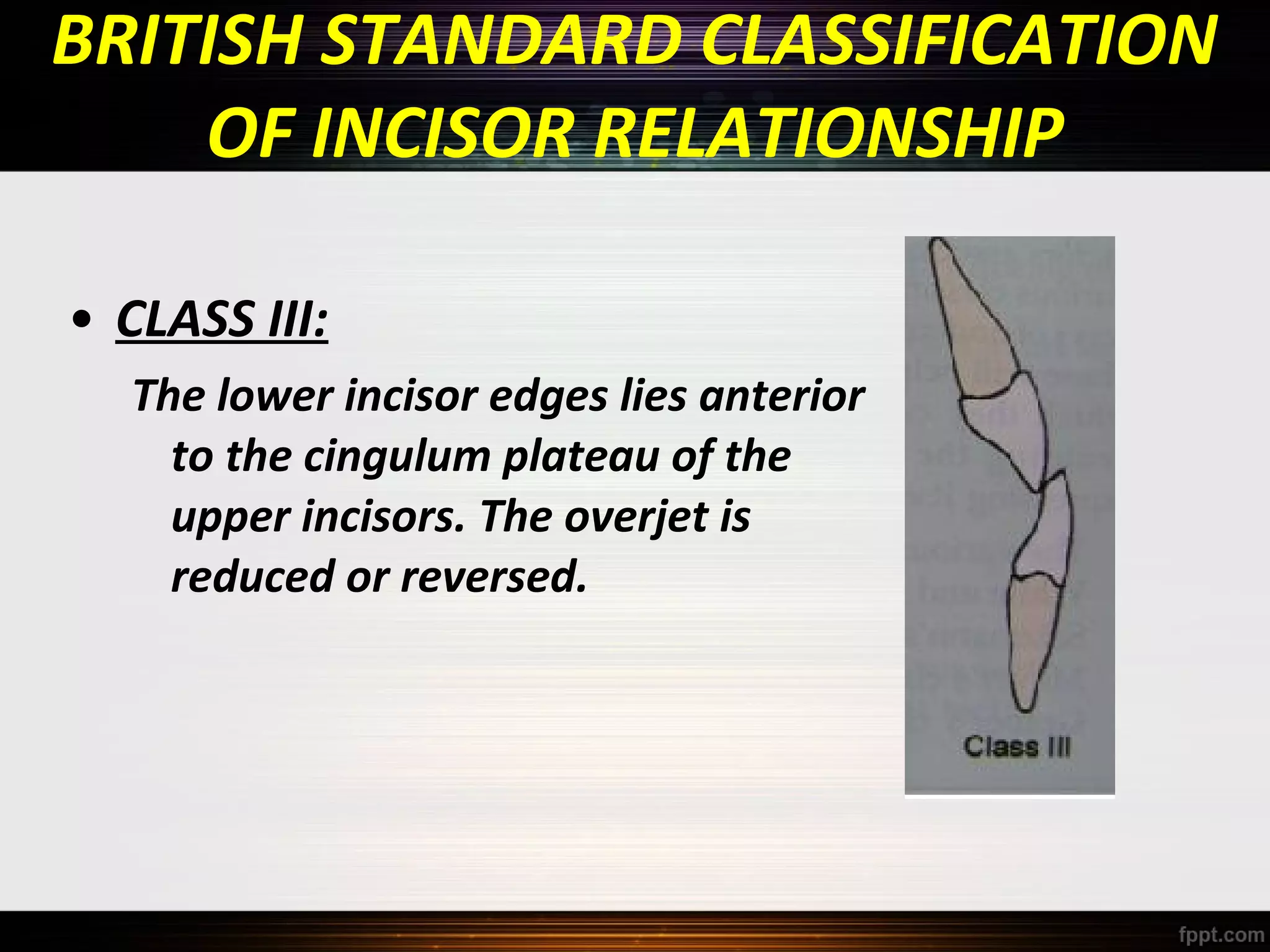 BRITISH STANDARD CLASSIFICATION
OF INCISOR RELATIONSHIP
• CLASS III:
The lower incisor edges lies anterior
to the cingulum plateau of the
upper incisors. The overjet is
reduced or reversed.

 