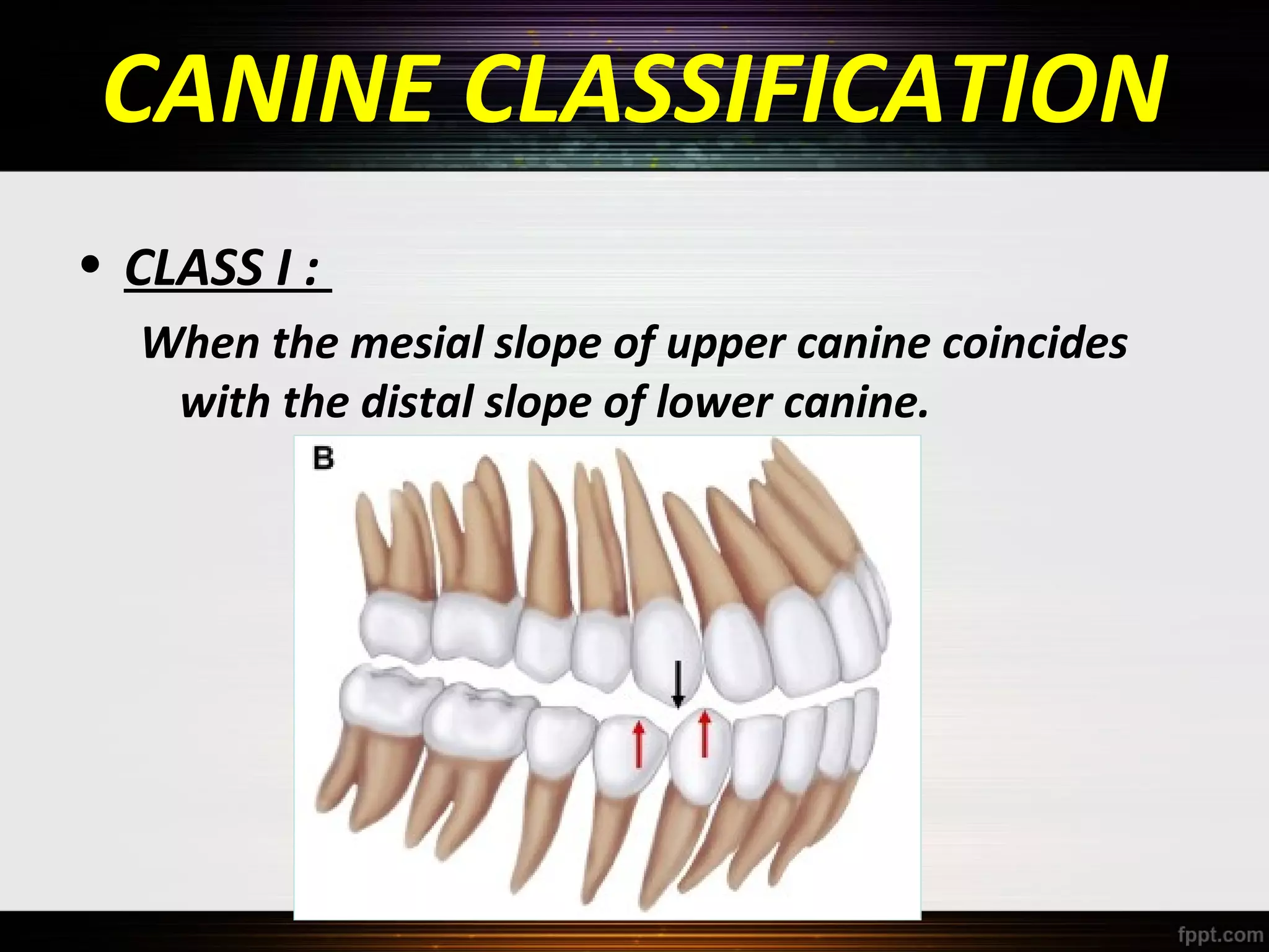 CANINE CLASSIFICATION
• CLASS I :
When the mesial slope of upper canine coincides
with the distal slope of lower canine.

 