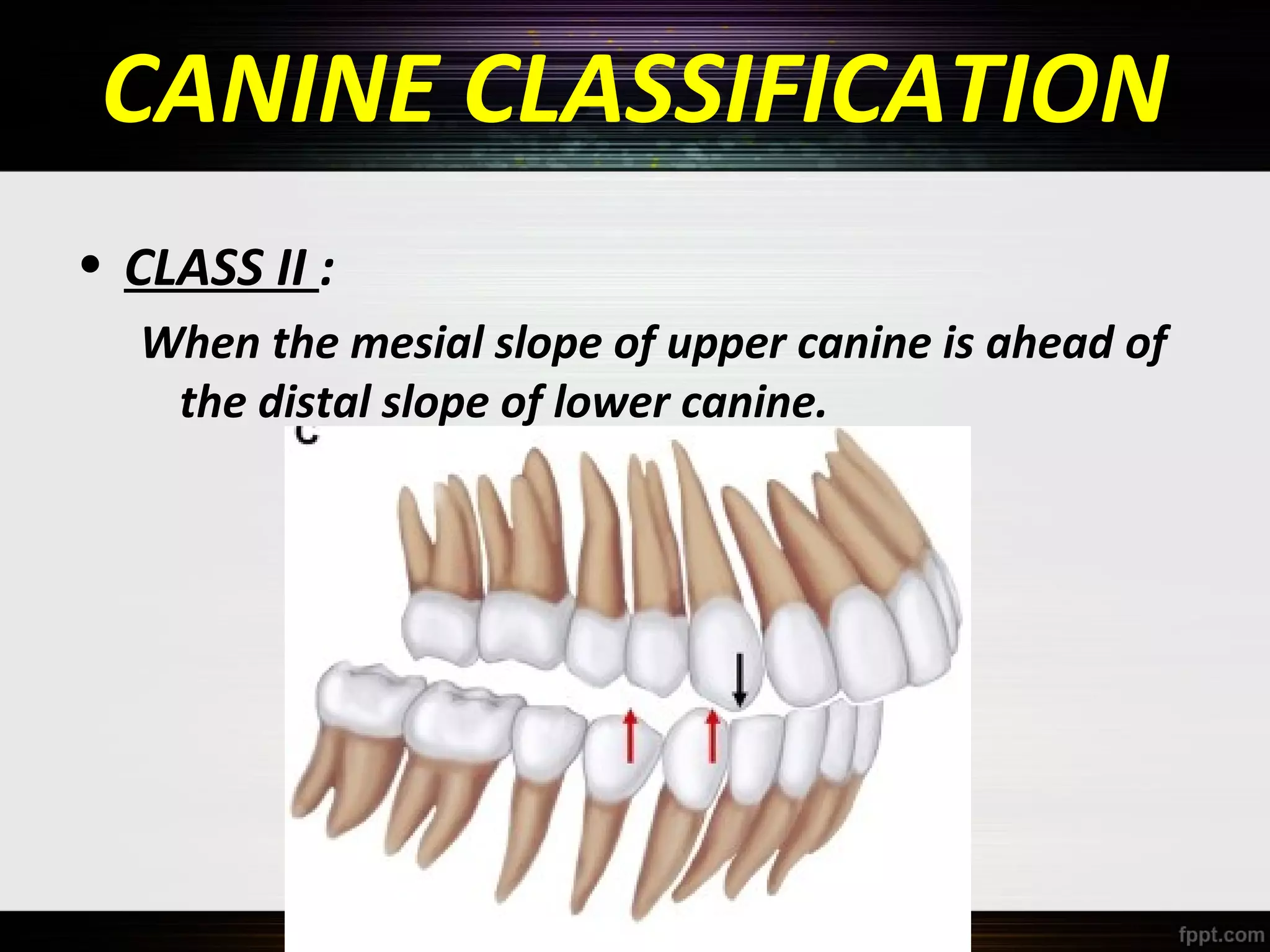 CANINE CLASSIFICATION
• CLASS II :
When the mesial slope of upper canine is ahead of
the distal slope of lower canine.

 