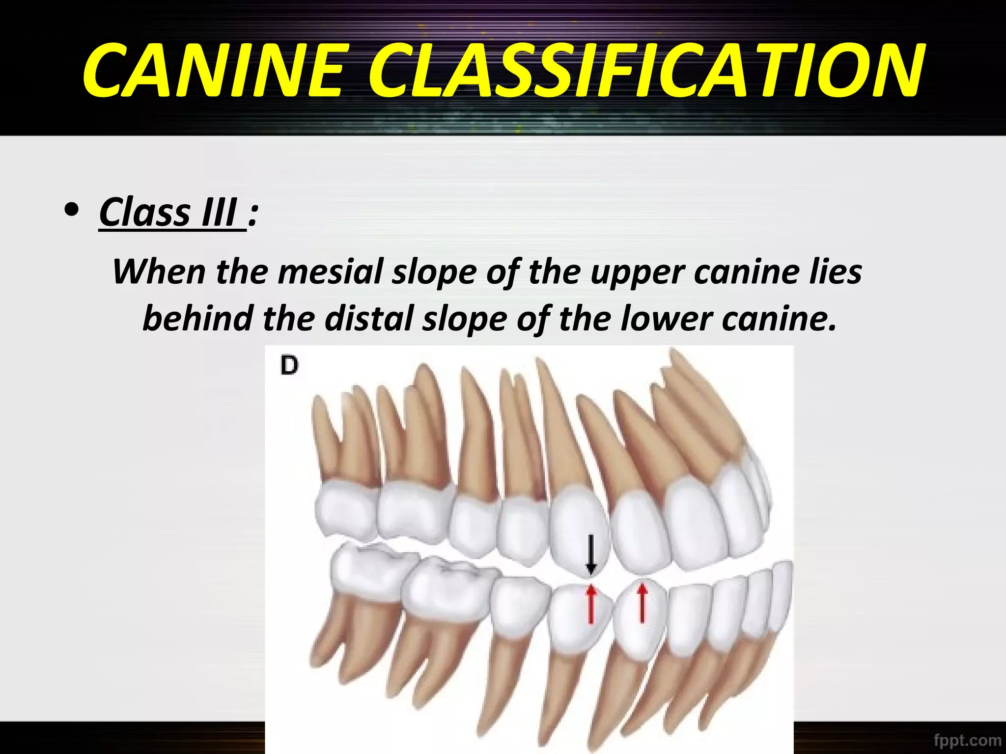 CANINE CLASSIFICATION
• Class III :
When the mesial slope of the upper canine lies
behind the distal slope of the lower canine.

 