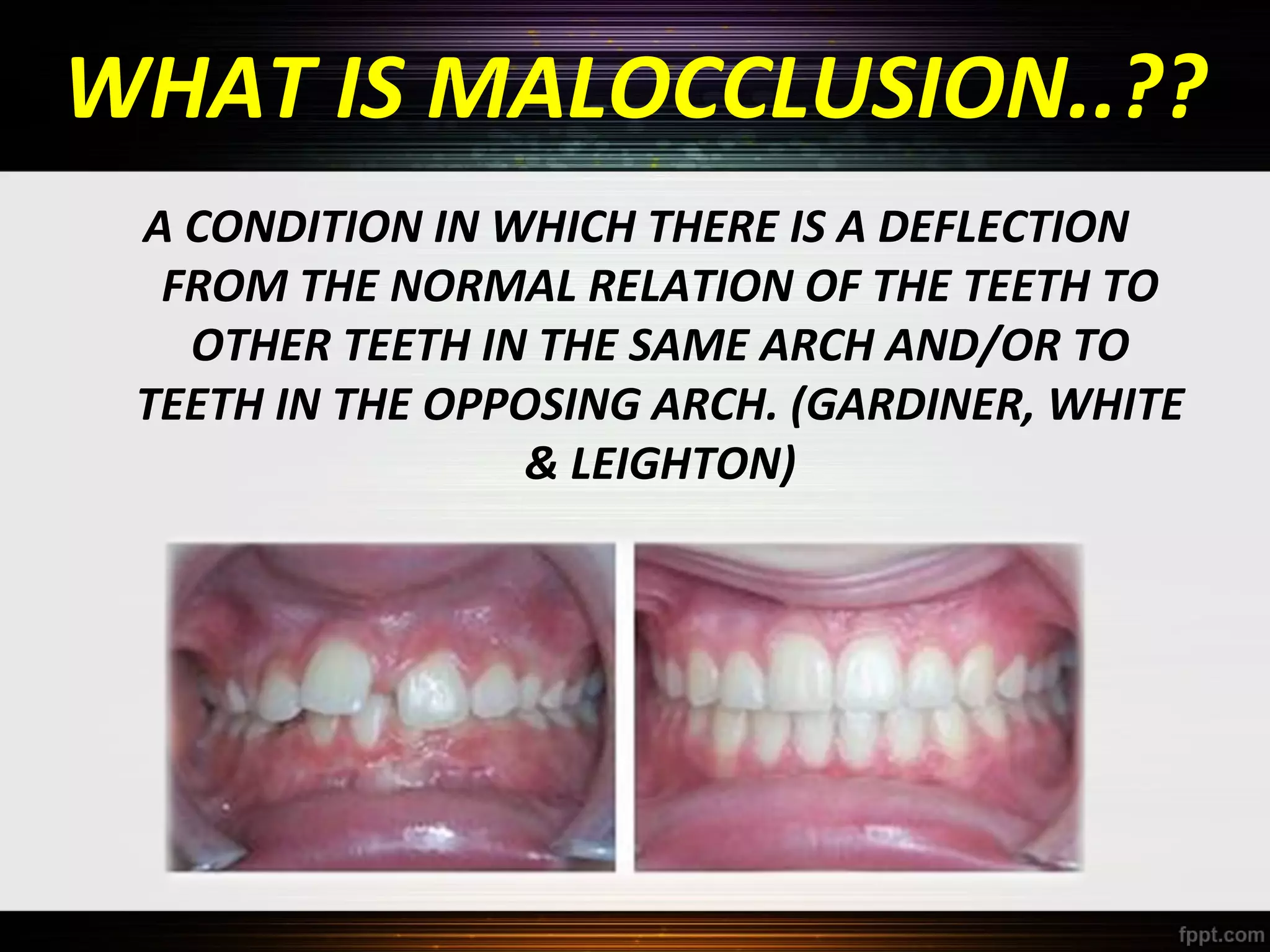 WHAT IS MALOCCLUSION..??
A CONDITION IN WHICH THERE IS A DEFLECTION
FROM THE NORMAL RELATION OF THE TEETH TO
OTHER TEETH IN THE SAME ARCH AND/OR TO
TEETH IN THE OPPOSING ARCH. (GARDINER, WHITE
& LEIGHTON)

 