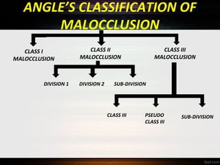 ANGLE’S CLASSIFICATION OF
MALOCCLUSION
CLASS I
MALOCCLUSION

DIVISION 1

CLASS II
MALOCCLUSION

DIVISION 2

CLASS III
MALOCCLUSION

SUB-DIVISION

CLASS III

PSEUDO
CLASS III

SUB-DIVISION

 