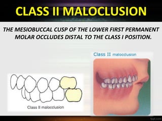 CLASS II MALOCLUSION
THE MESIOBUCCAL CUSP OF THE LOWER FIRST PERMANENT
MOLAR OCCLUDES DISTAL TO THE CLASS I POSITION.

 