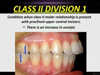 CLASS II DIVISION 1
Condition when class II molar relationship is present
with proclined upper central incisors.
• There is an increase in overjet.

 