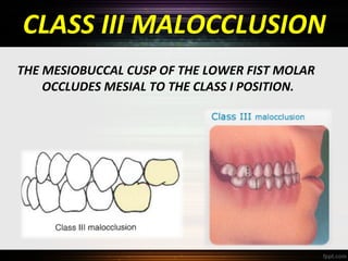 CLASS III MALOCCLUSION
THE MESIOBUCCAL CUSP OF THE LOWER FIST MOLAR
OCCLUDES MESIAL TO THE CLASS I POSITION.

 