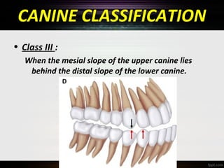 CANINE CLASSIFICATION
• Class III :
When the mesial slope of the upper canine lies
behind the distal slope of the lower canine.

 