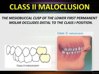 Classification of malocclusion