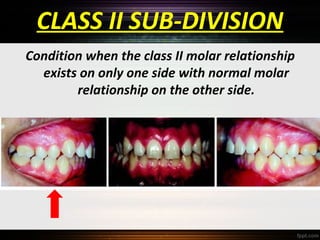Classification of malocclusion
