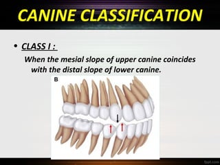 Classification of malocclusion | PPT
