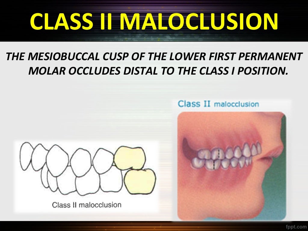 Classification of malocclusion