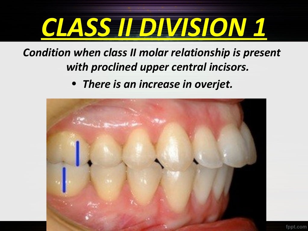 Classification of malocclusion