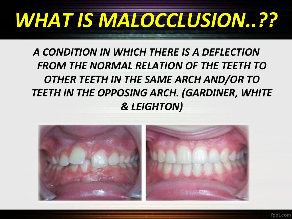 Classification of malocclusion