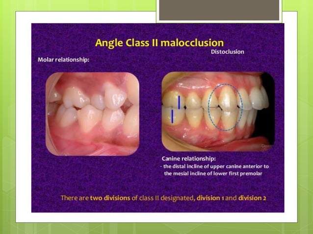 Classification of malocclusion | PPT