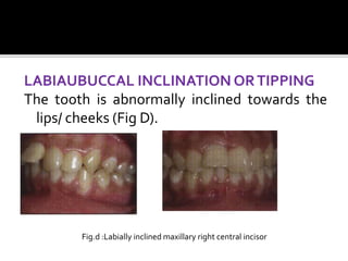 Classification of malocclusion | PPT