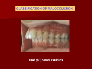 PROF (Dr.) SAIBEL FARISHTA
CLASSIFICATION OF MALOCCLUSION
 