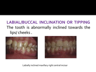 LABIAL/BUCCAL INCLINATION OR TIPPING
The tooth is abnormally inclined towards the
lips/ cheeks .
Labially inclined maxillary right central incisor
 