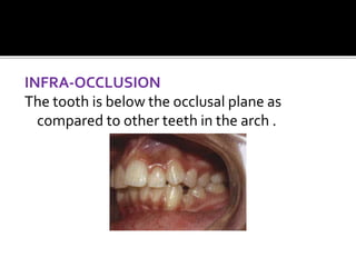 INFRA-OCCLUSION
The tooth is below the occlusal plane as
compared to other teeth in the arch .
 