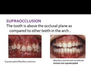 SUPRAOCCLUSION
The tooth is above the occlusal plane as
compared to other teeth in the arch .
Maxillary central and mandibular
incisors are supraerupted
Supraerupted Maxillary anteriors
 