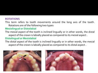 ROTATIONS
This term refers to tooth movements around the long axis of the tooth.
Rotations are of the following two types:
Mesiolingual or Distolabial
The mesial aspect of the tooth is inclined lingually or in other words, the distal
aspect of the crown is labially placed as compared to its mesial aspect .
Distolingual or Mesiolabial
The distal aspect of the tooth is inclined lingually or in other words, the mesial
aspect of the crown is labially placed as compared to its distal aspect .
 