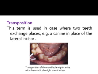 Transposition
This term is used in case where two teeth
exchange places, e.g. a canine in place of the
lateral incisor .
Transposition of the mandibular right canine
with the mandibular right lateral incisor
 