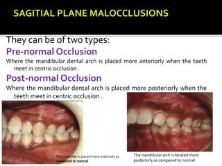 They can be of two types:
Pre-normal Occlusion
Where the mandibular dental arch is placed more anteriorly when the teeth
meet in centric occlusion .
Post-normal Occlusion
Where the mandibular dental arch is placed more posteriorly when the
teeth meet in centric occlusion .
The mandibular arch is located more
posteriorly as compared to normal
The mandible is placed more anteriorly as
compared to normal
 