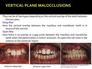 They can be of two types depending on the vertical overlap of the teeth between
the two jaws.
Deep Bite
Here the vertical overlap between the maxillary and mandibular teeth is in
excess of the normal .
Open Bite
Here there is no overlap or a gap exists between the maxillary and mandibular
teeth when the patient bites in centric occlusion. An open bite can exist in the
anterior or the posterior region.
Anterior open biteAnterior deep bite
Posterior open bite due to the presence of a
lateral tongue thrust habit
 
