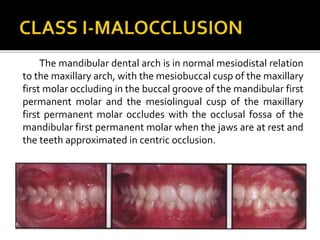The mandibular dental arch is in normal mesiodistal relation
to the maxillary arch, with the mesiobuccal cusp of the maxillary
first molar occluding in the buccal groove of the mandibular first
permanent molar and the mesiolingual cusp of the maxillary
first permanent molar occludes with the occlusal fossa of the
mandibular first permanent molar when the jaws are at rest and
the teeth approximated in centric occlusion.
 