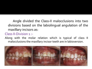 Angle divided the Class-II malocclusions into two
divisions based on the labiolingual angulation of the
maxillary incisors as:
Class II-Division 1 :-
Along with the molar relation which is typical of class II
malocclusions the maxillary incisor teeth are in labioversion.
 