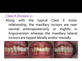 Class II-Division 2:-
Along with the typical Class II molar
relationship, the maxillary incisors are near
normal anteroposteriorly or slightly in
linguoversion whereas the maxillary lateral
incisors are tipped labially and/or mesially.
 