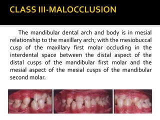 The mandibular dental arch and body is in mesial
relationship to the maxillary arch; with the mesiobuccal
cusp of the maxillary first molar occluding in the
interdental space between the distal aspect of the
distal cusps of the mandibular first molar and the
mesial aspect of the mesial cusps of the mandibular
second molar.
 