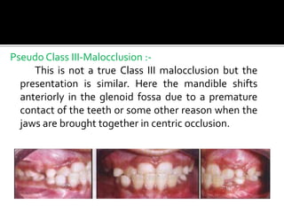Pseudo Class III-Malocclusion :-
This is not a true Class III malocclusion but the
presentation is similar. Here the mandible shifts
anteriorly in the glenoid fossa due to a premature
contact of the teeth or some other reason when the
jaws are brought together in centric occlusion.
 