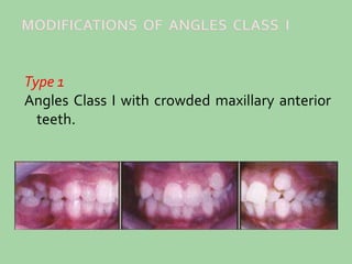 Type 1
Angles Class I with crowded maxillary anterior
teeth.
 