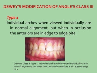 Type 1
Individual arches when viewed individually are
in normal alignment, but when in occlusion
the anteriors are in edge to edge bite.
Dewey's Class III Type 1. individual arches when viewed individually are in
normal alignment, but when in occlusion the anterlors are in edge to edge
bite
 