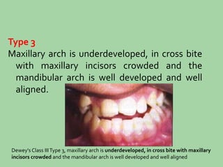Type 3
Maxillary arch is underdeveloped, in cross bite
with maxillary incisors crowded and the
mandibular arch is well developed and well
aligned.
Dewey's Class IIIType 3, maxillary arch is underdeveloped, in cross bite with maxillary
incisors crowded and the mandibular arch is well developed and well aligned
 