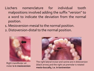 Lischers nomenclature for individual tooth
malpositions involved adding the suffix "version" to
a word to indicate the deviation from the normal
position.
1. Mesioversion-mesial to the normal position.
2. Distoversion-distal to the normal position.
Right mandibular 1st
molar is in mesioversion
The right lateral incisor and canine are in distoversion
(black arrow),and the right 1st premolar is rotated
mesio-buccally, i.e. in torsiversion
 