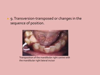  9.Transversion-transposed or changes in the
sequence of position.
Transposition of the mandibular right canine with
the mandibular right lateral incisor
 