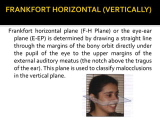 Frankfort horizontal plane (F-H Plane) or the eye-ear
plane (E-EP) is determined by drawing a straight line
through the margins of the bony orbit directly under
the pupil of the eye to the upper margins of the
external auditory meatus (the notch above the tragus
of the ear). This plane is used to classify malocclusions
in the vertical plane.
 