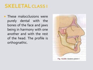  These malocclusions were
purely dental with the
bones of the face and jaws
being in harmony with one
another and with the rest
of the head. The profile is
orthognathic.
 