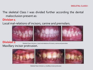 The skeletal Class I was divided further according the dental
malocclusion present as:
Division 1
Local mal-relations of incisors, canine and prernolars.
Division 2
Maxillary incisor protrusion.
Skeletal Class I division 1; local mal relations of incisors, canine and premolars
Skeletal Class I division 2; maxillary incisor protrusion
 