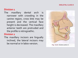 Division 1
The maxillary dental arch is
narrower with crowding in the
canine region, cross bite may be
present and the vertical face
height is decreased. The maxillary
anterior teeth are protruded and
the profile is retrognathic.
Division 2
The maxillary incisors are lingually
inclined, the lateral incisors may
be normal or in labio-version.
 
