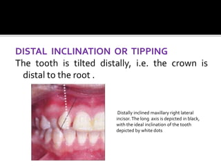 DISTAL INCLINATION OR TIPPING
The tooth is tilted distally, i.e. the crown is
distal to the root .
Distally inclined maxillary right lateral
incisor.The long axis is depicted in black,
with the ideal inclination of the tooth
depicted by white dots
 