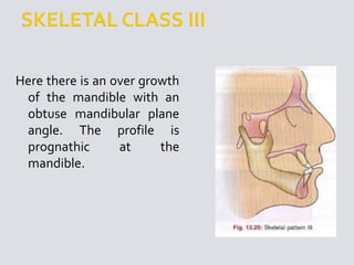 Here there is an over growth
of the mandible with an
obtuse mandibular plane
angle. The profile is
prognathic at the
mandible.
 