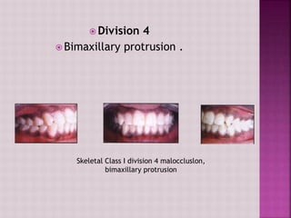 Classification ofmalocclusion | PPTX