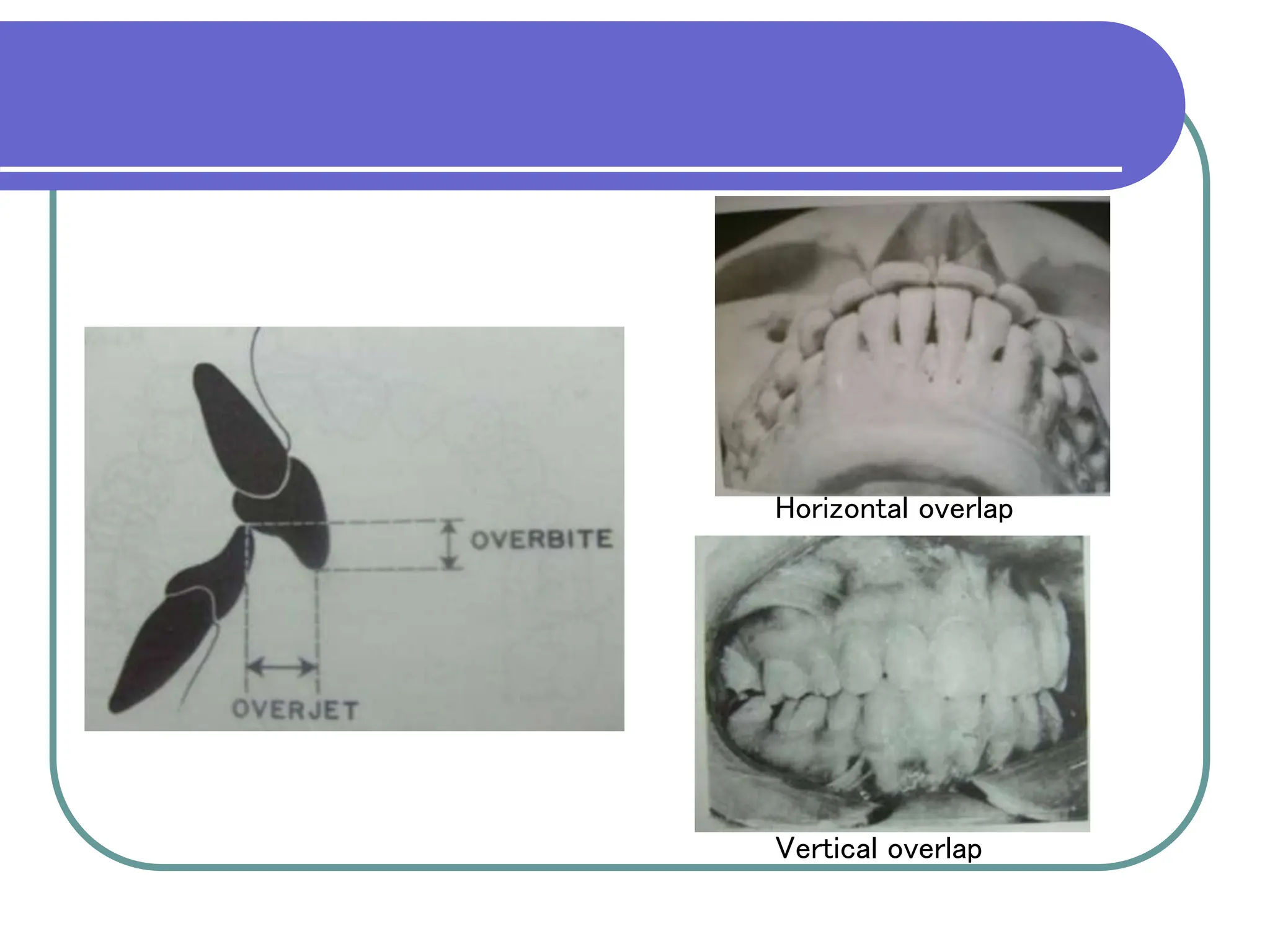 CLASSIFICATION OF MALOCCLUSION.ppt
