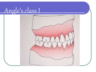 CLASSIFICATION OF MALOCCLUSION.ppt