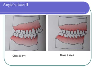 CLASSIFICATION OF MALOCCLUSION.ppt